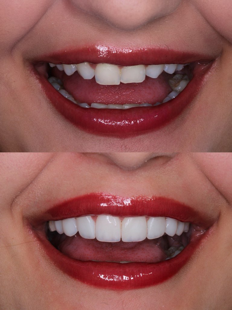 Resultado de lentes em resina - antes e depois